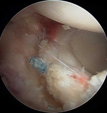 Hip arthroscopy. Labral repair with wraparound tec
