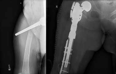 Periprosthetic fracture at stem of hip replacement