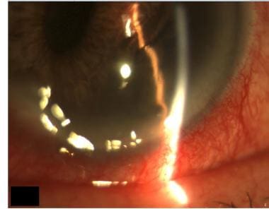 Inferior iris melanoma of the left eye that is pus