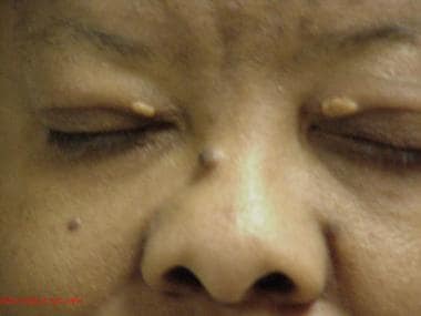 Xanthelasma palpebrarum in a patient with familial