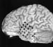 Identificación de candidatos potenciales para cirugía de epilepsia