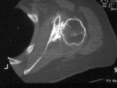 CT scan can be used to assess the amount of bone l