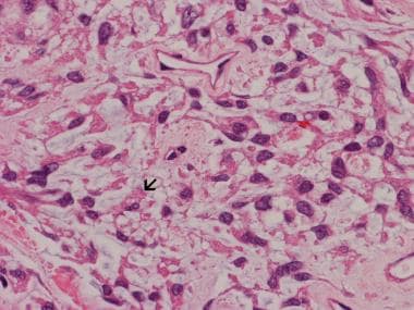 Meningiomas Pathology. In this chordoid meningioma
