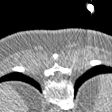 CT fluoroscopic image from a thoracic nerve root b