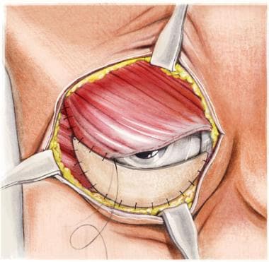 Delayed Breast Reconstruction  UPMC Western Maryland Plastic Surgery