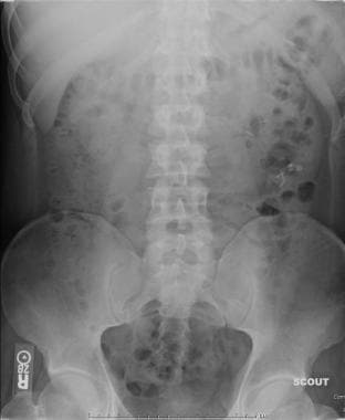 Excretory urography with Lasix: A plain radiograph