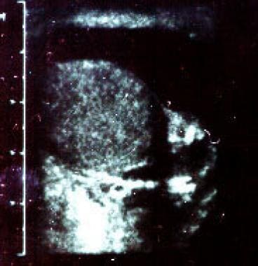 Scrotal sonogram showing the testes adjacent to th