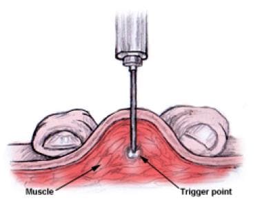 Trigger point injection. 