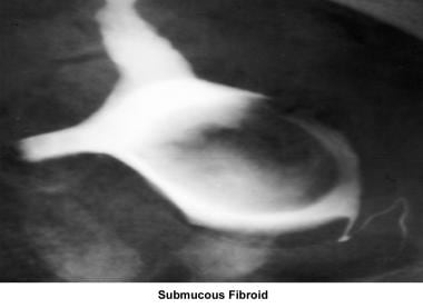 Infertility. Submucous fibroid. Image courtesy of 