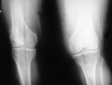 This radiograph demonstrates osteoarthritis of bil