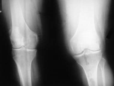 hip osteoarthritis medscape