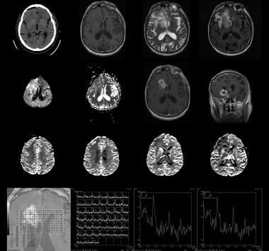 Recurrent grade IV astrocytoma in the region of th