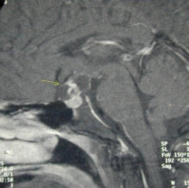 Sagittal contrast-enhanced T1-weighted MRI demonst