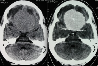 Transverse axial CT without and with contrast show