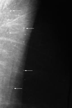 Projection proportion. E: most inferior point of the breast from the