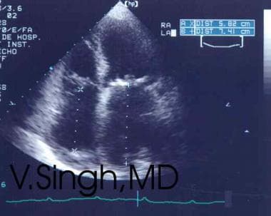 Rheumatic mitral stenosis with commissural fusion 