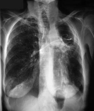 Posteroanterior chest radiograph shows a left uppe