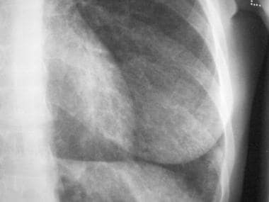 Magnified view of the left lung base shows reticul