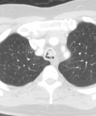 Axial CT scan shows a large metastatic mass in the