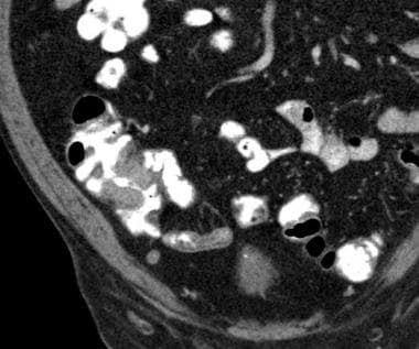 Preoperative CT: Cecal carcinoma with circumferent