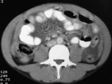 CT scan in an HIV-positive patient with intra-abdo