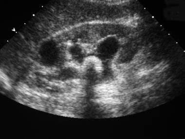 Renal sonogram demonstrates an echogenic shadowing