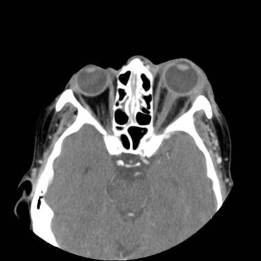 Axial postcontrast CT scan of a 56-year-old woman 