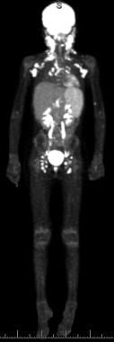 A positron emission tomography-computed tomography