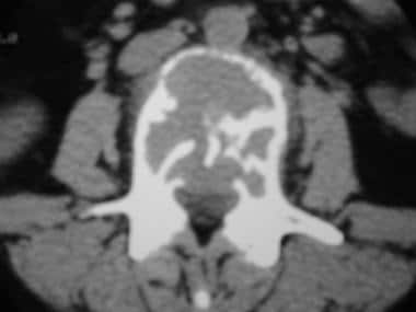 CT scan of the L3 vertebra shows a giant cell tumo