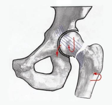 femoral neck fracture