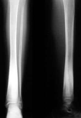 Osteomyelitis, chronic. Sclerosing osteomyelitis o