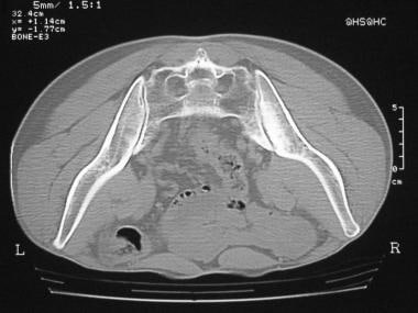 Reactive arthritis. Prone pelvic CT scan shows rig