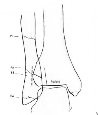 Diagram showing the typical locations for ankle fr