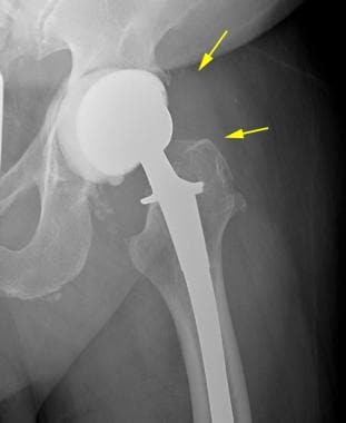 Anteroposterior radiograph depicts a metal-on-meta