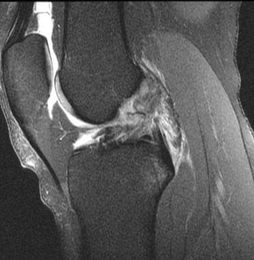 Acute anterior cruciate ligament (ACL) tear. T2-we