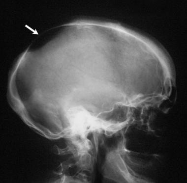 Skull radiograph in a 76-year-old woman presenting