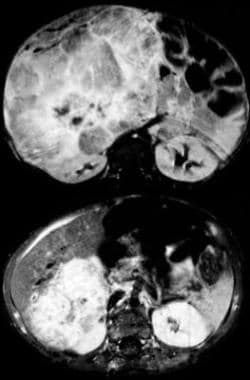 Contrast-enhanced, fat-suppressed, axial, T-1 weig