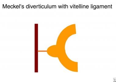 Diagram shows a Meckel diverticulum with vitelline
