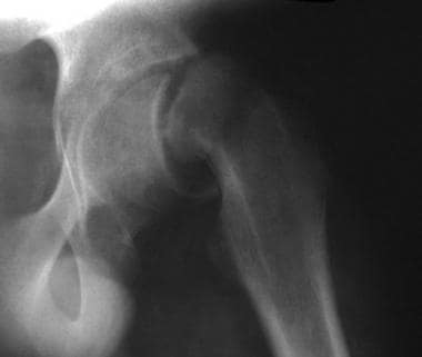 Slipped capital femoral epiphysis. This child had 