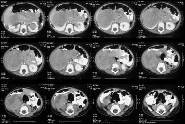 Enhanced axial CT scan shows a large solid tumor d