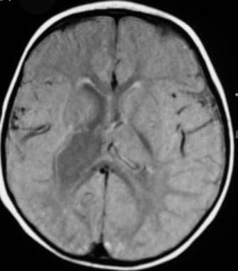 Axial image shows a distorted right lateral ventri