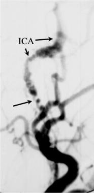Lateral angiogram of the internal carotid artery (