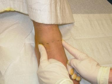 Line of anesthesia from lateral malleolus to media