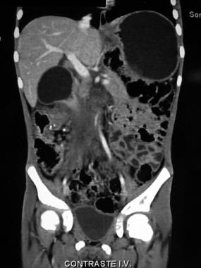 冠状位CT扫描显示大量肿瘤