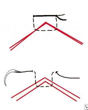 Half-buried horizontal suture (tip stitch, three-p