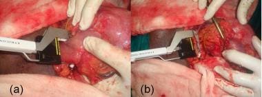 (a) Subtotal gastrectomy in progress. Linear stapl