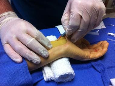 Radial artery cannulation (Seldinger). Skin incisi