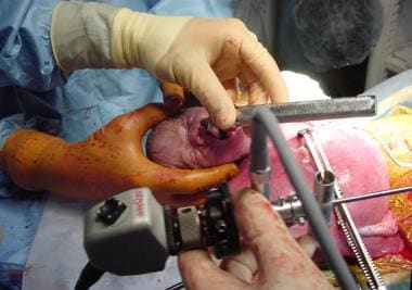 Ex-utero intrapartum treatment (EXIT) procedure. 