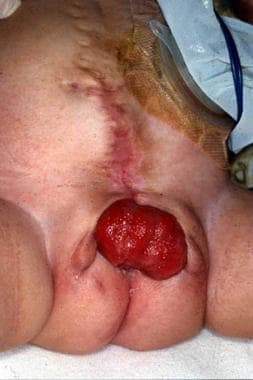 Subtotal prolapse of bladder wall through patulous
