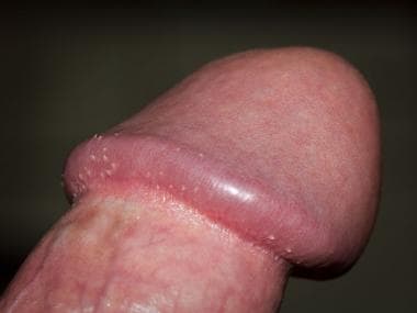 Pearly penile papules. Courtesy of Wiki Commons 